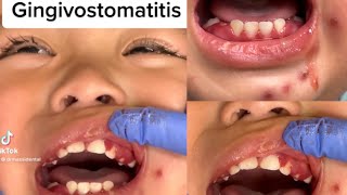 Herpetic Gingivostomatitis in Kids [upl. by Calabrese607]