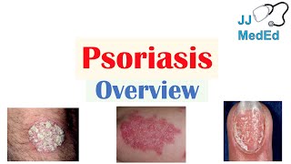 Overview of Psoriasis  What Causes It What Makes It Worse  Subtypes and Treatment [upl. by Aicercul]