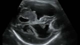 Fetal Medicine Foundation  Porencephalic cyst [upl. by Scopp]