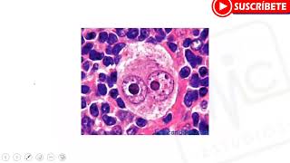 HEMATOLOGÍA Linfoma Hodking y No Hodking  MYC estudios [upl. by Nahsin]