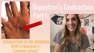 What Is Dupuytrens Contracture A Basic Introduction [upl. by Uund]