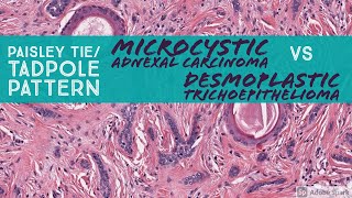 Microcystic Adnexal Carcinoma vs Desmoplastic Trichoepithelioma Paisley TieTadpole Pattern [upl. by Og817]