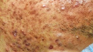 Acné kystiques et enlever les boutons sur le visage  cystic acne extraction [upl. by Eolanda121]