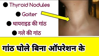 goiter  Thyroid nodule treatment  thyroid cyst treatment  r 51 drop  kanchnar gugul  Dr tarun [upl. by Latihs]