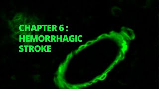 Stroke Made Simple Chapter 6 Hemorrhagic Stroke [upl. by Higbee]