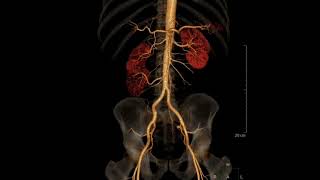 CT scan case 77Duplex kidney with triple renal arteriesctscan radiology radiologist radiologia [upl. by Erhard]