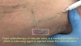 Foam sclerotherapy for treating spider veins and varicose veins [upl. by Baoj643]