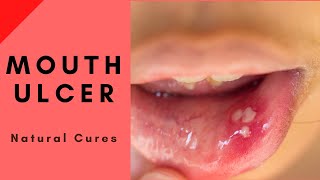 Natural Home Cures for Mouth Ulcers cankers or aphthous [upl. by Dimitri407]