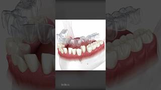 How Does Invisalign Aligners Work To Straighten Teeth [upl. by Milicent]