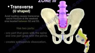 Sacral Fractures  Review  Everything You Need To Know  Dr Nabil Ebraheim [upl. by Kessiah]