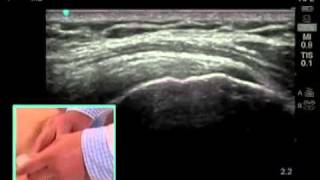 How To Ultrasound Guided Shoulder Injection Scanning Technique Video [upl. by Yborian113]