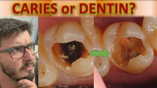 Until Where to Remove Caries on Dentin TUTORIAL Deep Caries Removal How to Radiology Detection [upl. by Bork348]