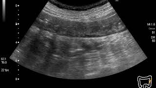 ischemic colitis [upl. by Jorgenson]