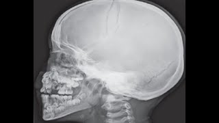 wormian bones differential diagnosis FRCR paediatric exam [upl. by Kobi]