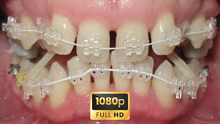 🔥HOW BRACES WORK  TIMELAPSE of Terrible GUMMY smile and DEEP bite [upl. by Gayn]