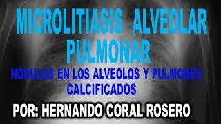 MICROLITIASIS ALVEOLAR PULMONAR  NÓDULOS EN LOS ALVEOLOS Y PULMONES CALCIFICADOS [upl. by Frayne]