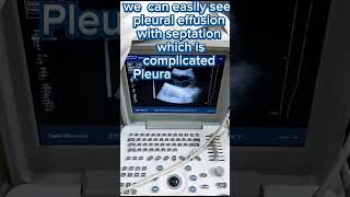 Pleural Effusion on ultrasound  ultrasound chest  complicated effusion [upl. by Trotter618]