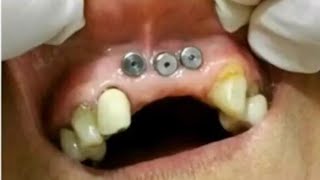 💣 IMPLANTES DENTÁRIOS ERRADOS   Quanto custa um IMPLANTE DENTÁRIO [upl. by Eibba]