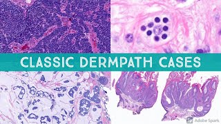 Classic Dermatopathology Cases from the Head amp Neck [upl. by Tarrel]