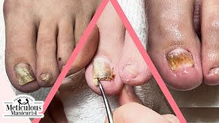 How to Fix Toenails that Change Shape and Color [upl. by Kooima]