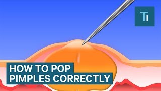 The Only Right Way To Pop Your Pimples [upl. by Bugbee]