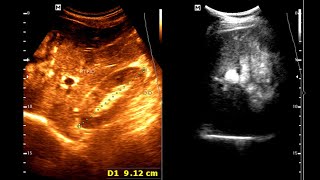 Sonographic Features of Gastric carcinoma  Limitations of Ultrasound  Complementary Imaging [upl. by Finnegan977]