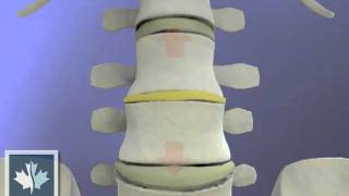 How Spinal Decompression Works  Back Clinics of Canada [upl. by Nepsa]