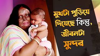 পোড়া মুখ দেখেও ও আমাকে বিয়ে করলো । Acid attack survivor। Bengali Podcast  Bengali Documentary [upl. by Katherina204]