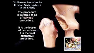 Girdlestone Procedure Hip Fractures Elderly  Everything You Need To Know  Dr Nabil Ebraheim [upl. by Nalhsa830]