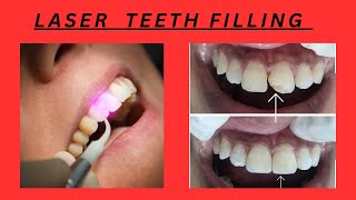 LASER FILLING MATERIAL  LASER TEETH FILLING  LASER VS BLUE LIGHT CURED COMPOSITE [upl. by Koenig]