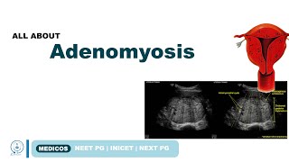 ADENOMYOSIS TYPES SYMPTOMS  DIAGNOSIS TREATMENT  NEETPG  INICET  MEDICOS [upl. by Annaer]