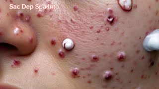 sac dep spa big deep blackheads  sac dep spa pimple popping Today new 2024 5 [upl. by Yenot]