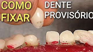 COMO FIXAR UM DENTE PROVISÓRIO  FAÇA VOCÊ MESMO [upl. by Aeneus39]