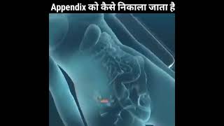 Appendix कैसे निकाला जाता है 😱🤯🤔🤨 [upl. by Kcirddes]