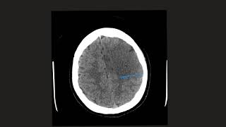 Cerebral Oedema Cytotoxic or Vasogenic Can you tell the difference [upl. by Nerdna170]