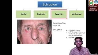 Ectropion Basics to Surgical aspects [upl. by Falkner]