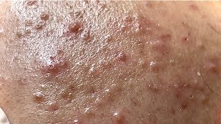 BLACKHEAD  ACNE TREATMENT MAI NGOC [upl. by Morrison]