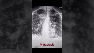 ☢️chest xray dises tb level🩻xray radiology shorts new hospital science medical [upl. by Monika]