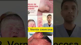 milia and vernix casecosa and lanugo shorts nursingeducation [upl. by Dranoc303]