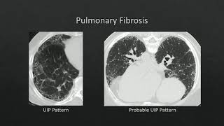 HRCT Pneumoconiosis [upl. by Thgiwd]