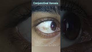 Xerophthalmia  Conjunctival Xerosis  Vitamin A Deficiencies [upl. by Troyes]