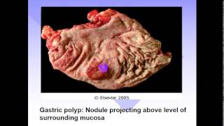 pathology  dr Dhaymaa  Stomach 2  Gastric Tumors اورام المعدة [upl. by Case]