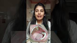 OperculectomyPericoronectomy ✅🦷✨ shortsviral dentistdoctor ytshorts shortvideo youtubeshorts [upl. by Notreve]