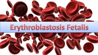 Erythroblastosis fetalisHaemolytic disease of New bornHDN [upl. by Moira939]