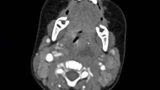 Retropharyngeal Abscess Imaging Studies short version [upl. by Wolfson]