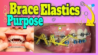 Brace Elastics Purpose [upl. by Merralee]