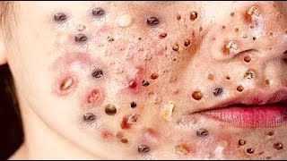 Top five dark blackhead removal  blackhead removal blackhead [upl. by Ahsiemat]