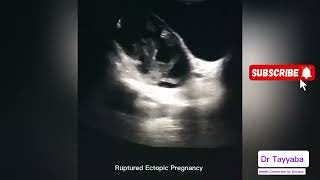 Ruptured Ectopic Pregnancy  Health Connection by Doctors [upl. by Anahsit943]