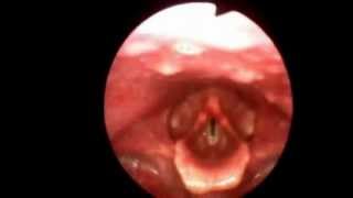 Flexible Video Stroboscopy Exam Kansas Voice Center [upl. by Niwdla]