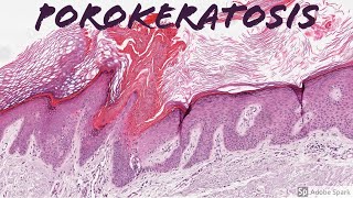 Porokeratosis 5Minute Pathology Pearls [upl. by Neivad]